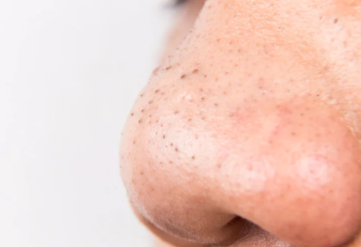 メンズ 毛穴 いちご鼻 ケア