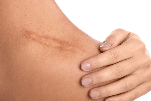 ケロイド　脱毛　できる？