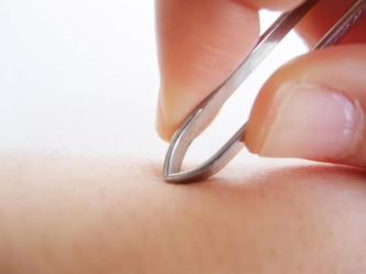 VIOの毛は抜くな！炎症や臭いへの影響を解説！